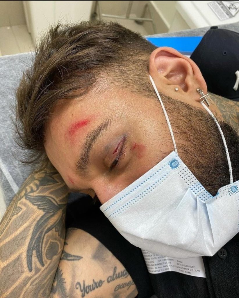 Cantor Lucas Lucco fica com rosto ferido e dedo quebrado em acidente doméstico: ‘Bebi demais’