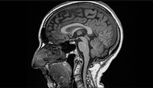 Saúde Covid-19 pode causar encolhimento do cérebro e perda de memória, mostra estudo
