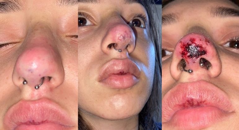Jovem fica com nariz necrosado após procedimento estético mal sucedido