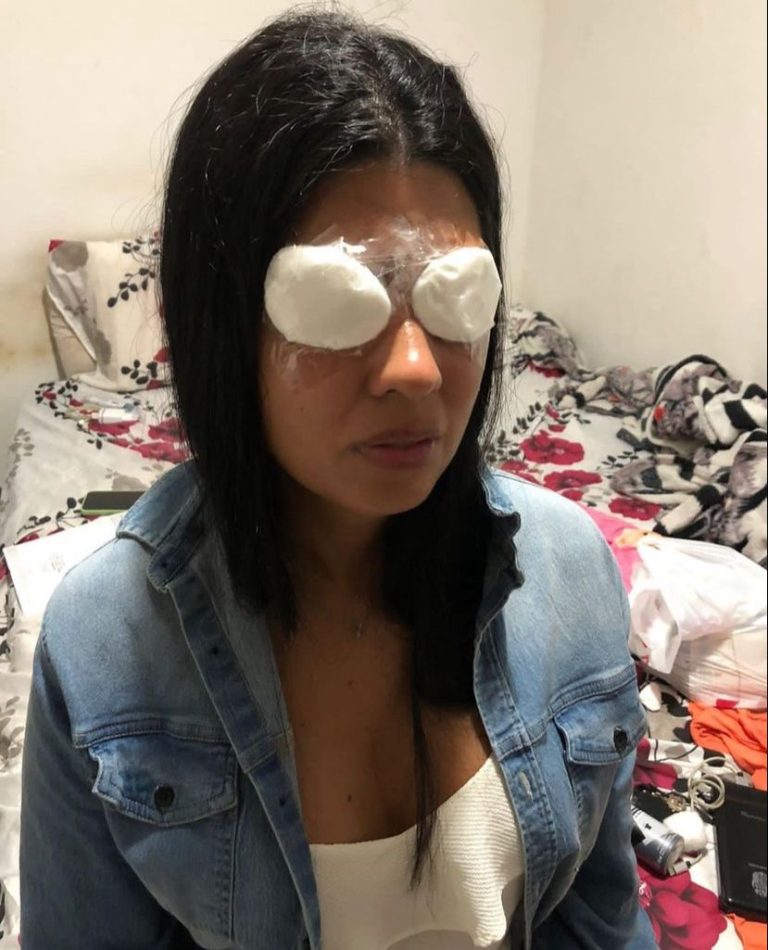 Jovem potiguar fica temporariamente cega após usar pomada no cabelo para fazer tranças