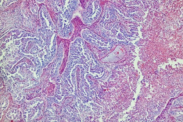 Hepatite misteriosa pode estar ligada ao coronavírus, sugere estudo