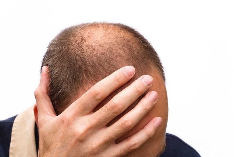 Chamar homem de ‘careca’ é assédio sexual, decidem juízes ingleses