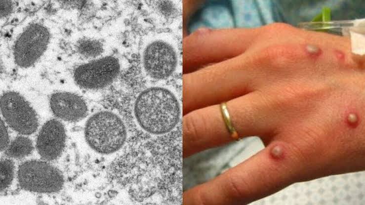 Primeiro caso de varíola dos macacos no Brasil é confirmado