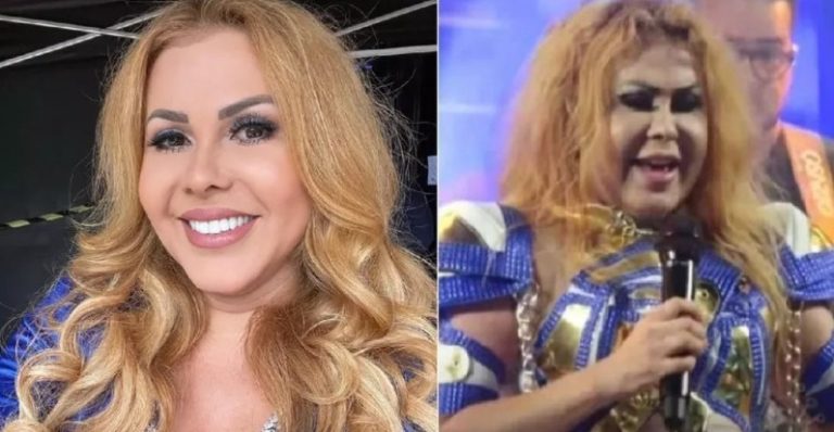 Cantora Joelma é internada em hospital de São Paulo (SP) com inchaço no rosto por sequelas de Covid-19