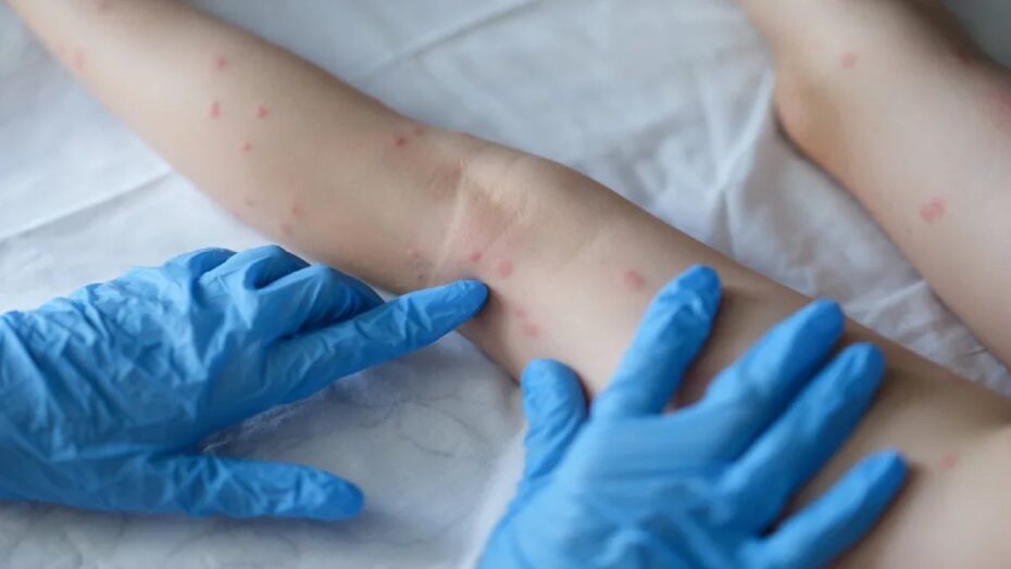 Primeiro infectado com varíola do macaco no Brasil recebe alta
