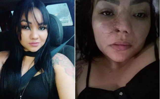 Mulher faz cirurgia estética com dentista e perde parte do nariz