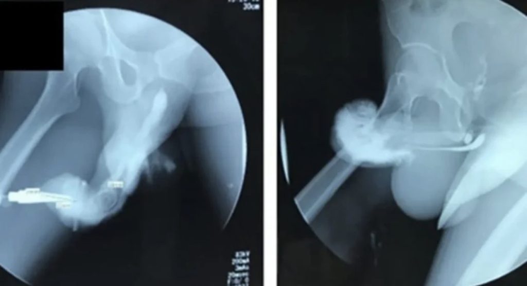 Homem quebra pênis e é diagnosticado com ‘deformidade berinjela