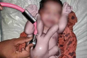 Após nascer com quatro braços e pernas, bebê é comparado a divindade hindu