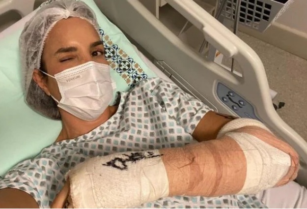 Ivete Sangalo faz cirurgia no braço após cair esquiando: “Zero bala”