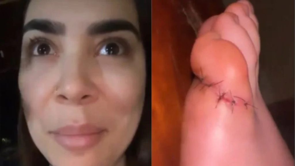 Naiara Azevedo leva cinco pontos no dedo do pé após acidente com faca