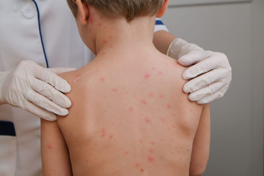 Avanço de casos e mortes por meningite acende alerta em SP