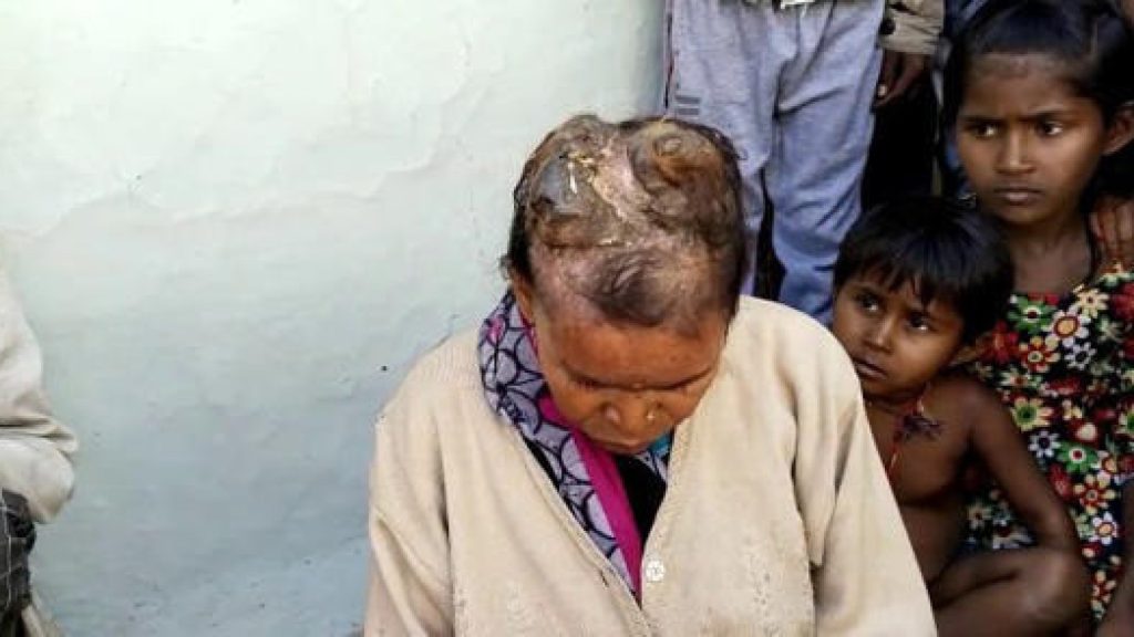 Mulher com doença rara desenvolve ‘chifres’ na cabeça: “Dor insuportável”