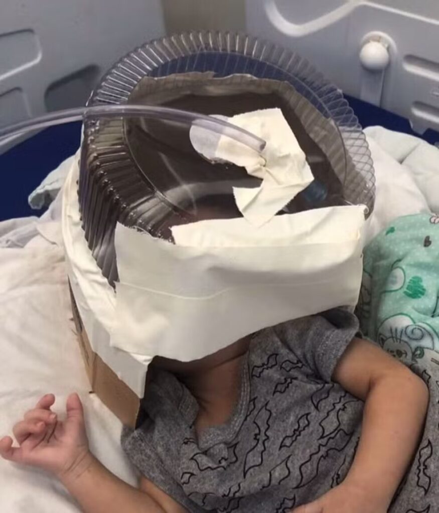 Bebê que usou máscara de oxigênio feita com embalagem de bolo em hospital morre em Natal